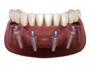 Full Arch Teeth Solutions