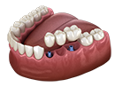 Implant Retained Bridge