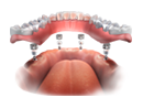 Overdentures